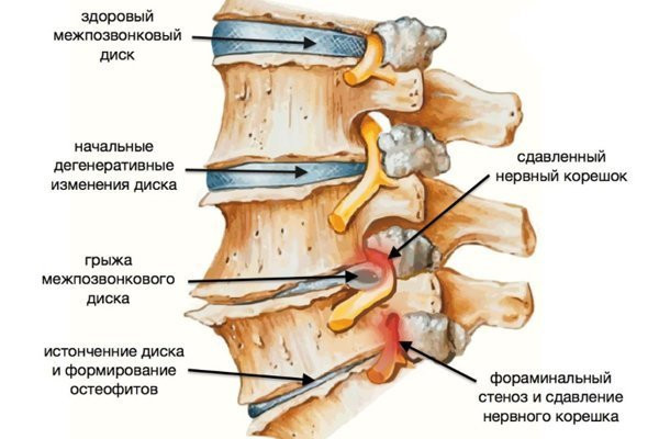 Захворювання хребта. Частина 1