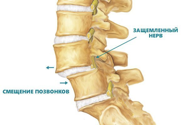 Захворювання хребта. Частина 2