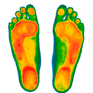 Компьютерная диагностика стоп на сканере и динамической платформе