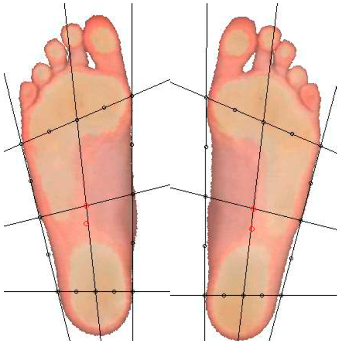 Компьютерная диагностика стоп на сканере и динамической платформе