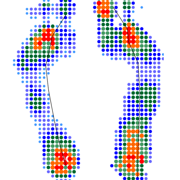 Компьютерная диагностика стоп на сканере и динамической платформе