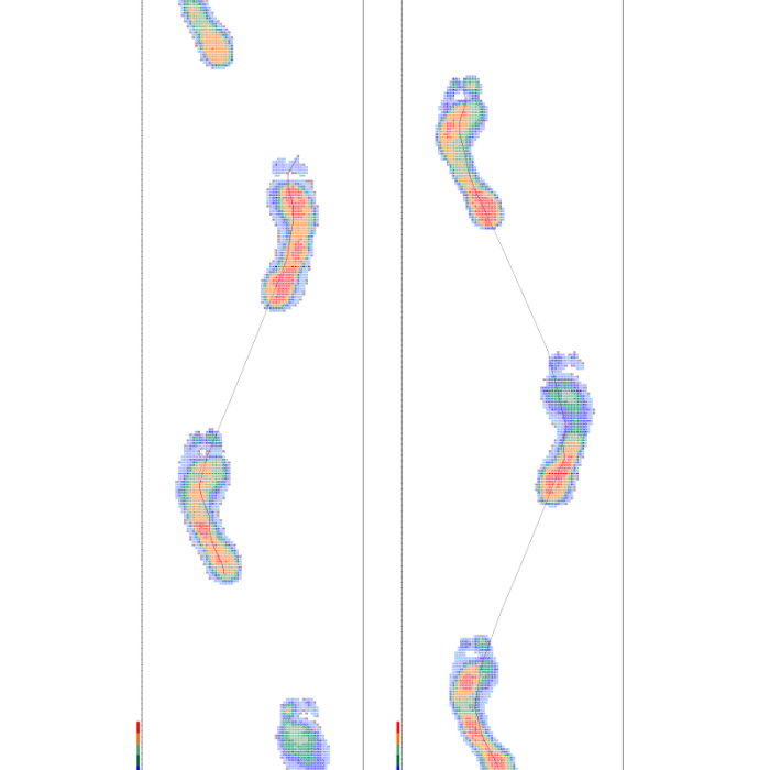 Компьютерная диагностика стоп на сканере и динамической платформе