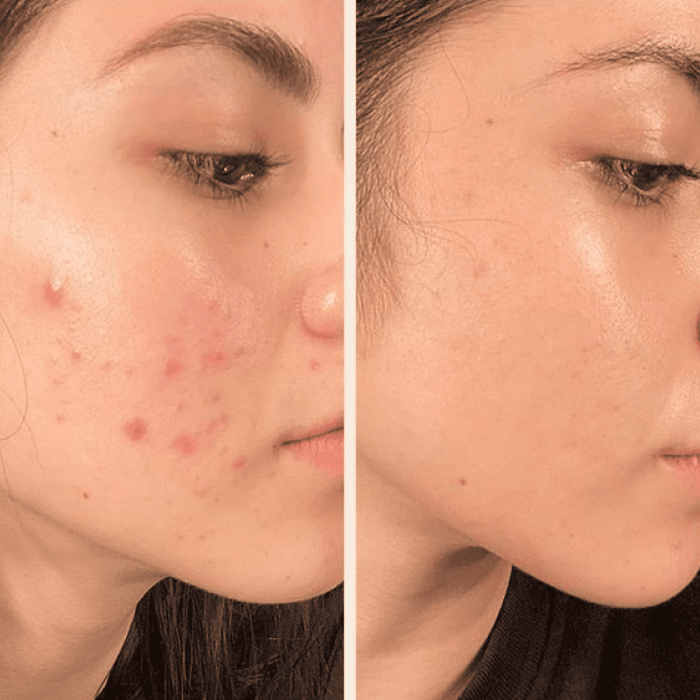 Портативний дарсонваль MEDICA+ DARSOLINE 7.0