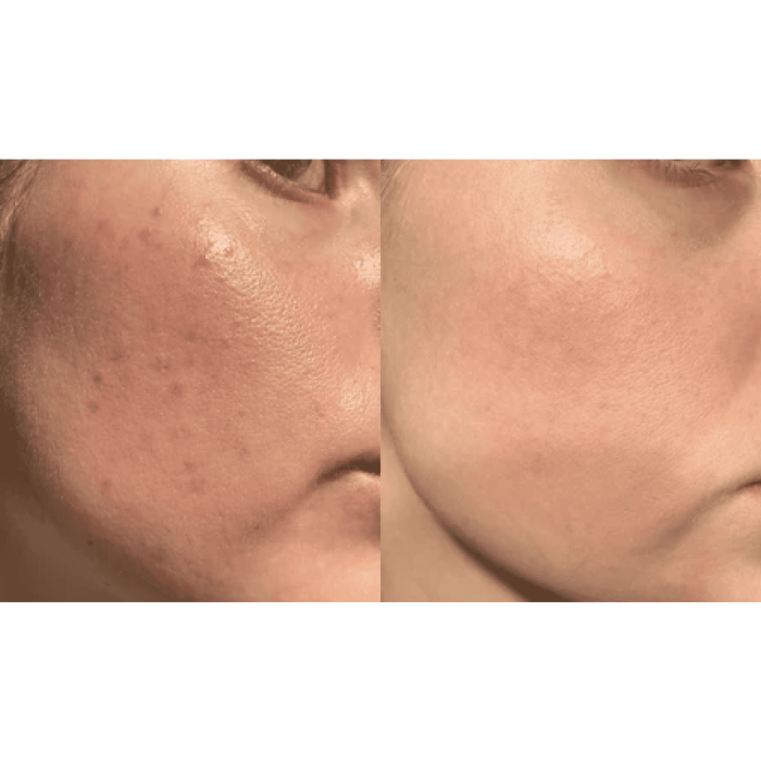 Портативний дарсонваль MEDICA+ DARSOLINE 4.0