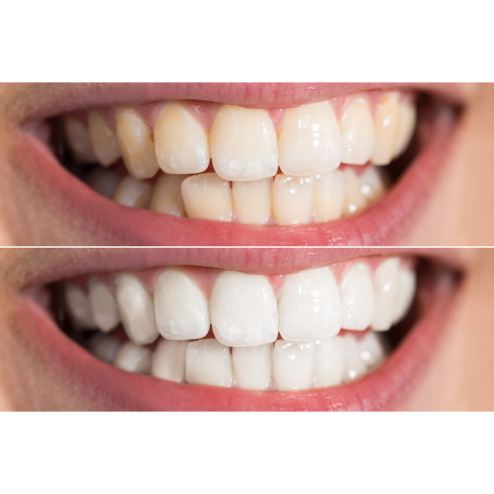 Відбілювальна капа для зубів Medica+ WhitePearl 10X White