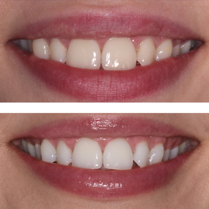 Відбілюючий коректор для кольору зубів MEDICA+ V34