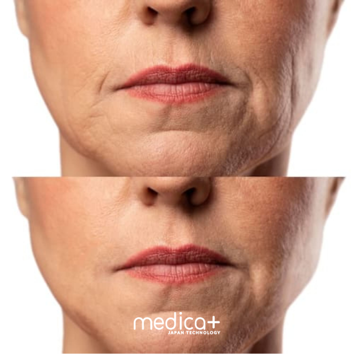 Набір Мікрострумовий RF Lifting Масажер для обличчя Skin Lifting 7.0 Pink + Струмопровідний гель + Порозвужувальна маска для обличчя MEDICA+